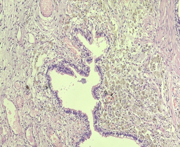 Патоморфологическое исследование пациентки С. Морфологическая картина эндометриоидной кисты мочевого пузыря. Окраска гематоксилин-эозином, х5