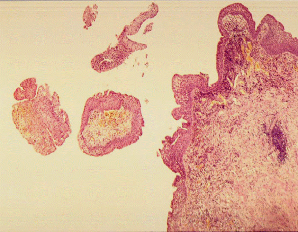 Патоморфологическое исследование пациентки К. Морфологическая картина полипоидного цистита. Окраска гематоксилин-эозином, х5