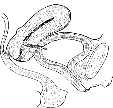 Схематическое изображение пузырно-маточного свища
