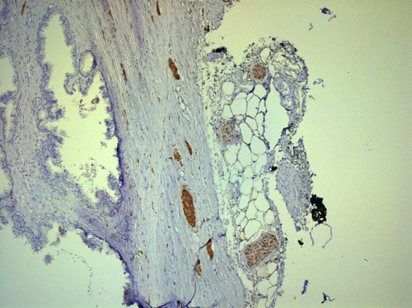 Нервные волокна в парапростатической ткани и капсуле простаты ИГХ окраска S100